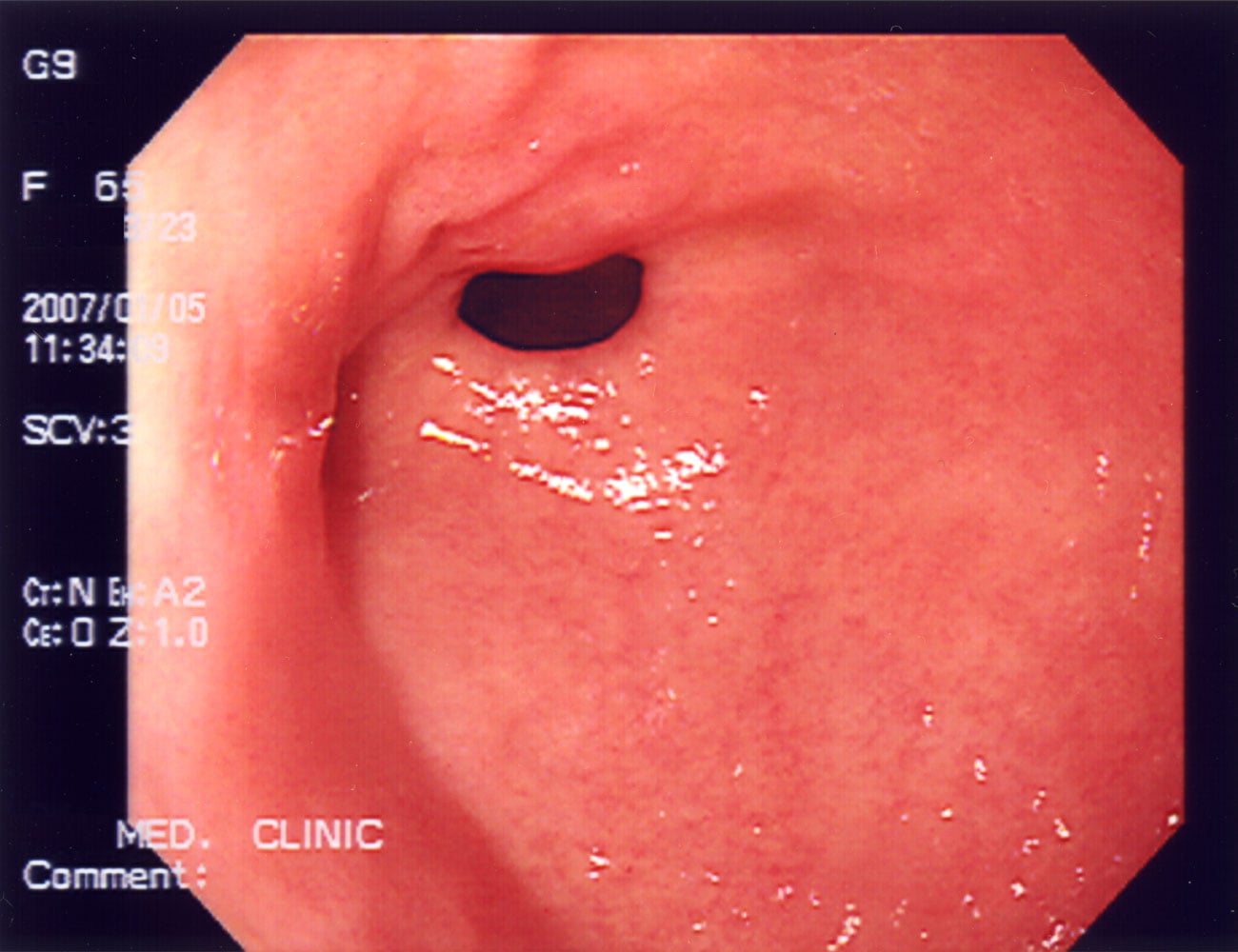 Endoscopic image showing the inner lining of an esophagus or similar organ, with a circular, smooth, pink tissue surface, and a dark, central opening. Medical data is overlaid on the image border.
