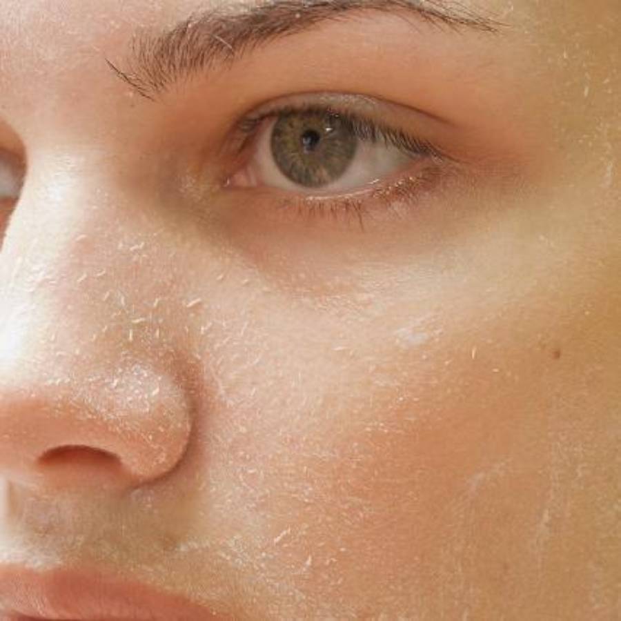 A close-up of a person's face with dry, flaky skin, showing visible patches of dryness around the cheek, nose, and under the eye area.