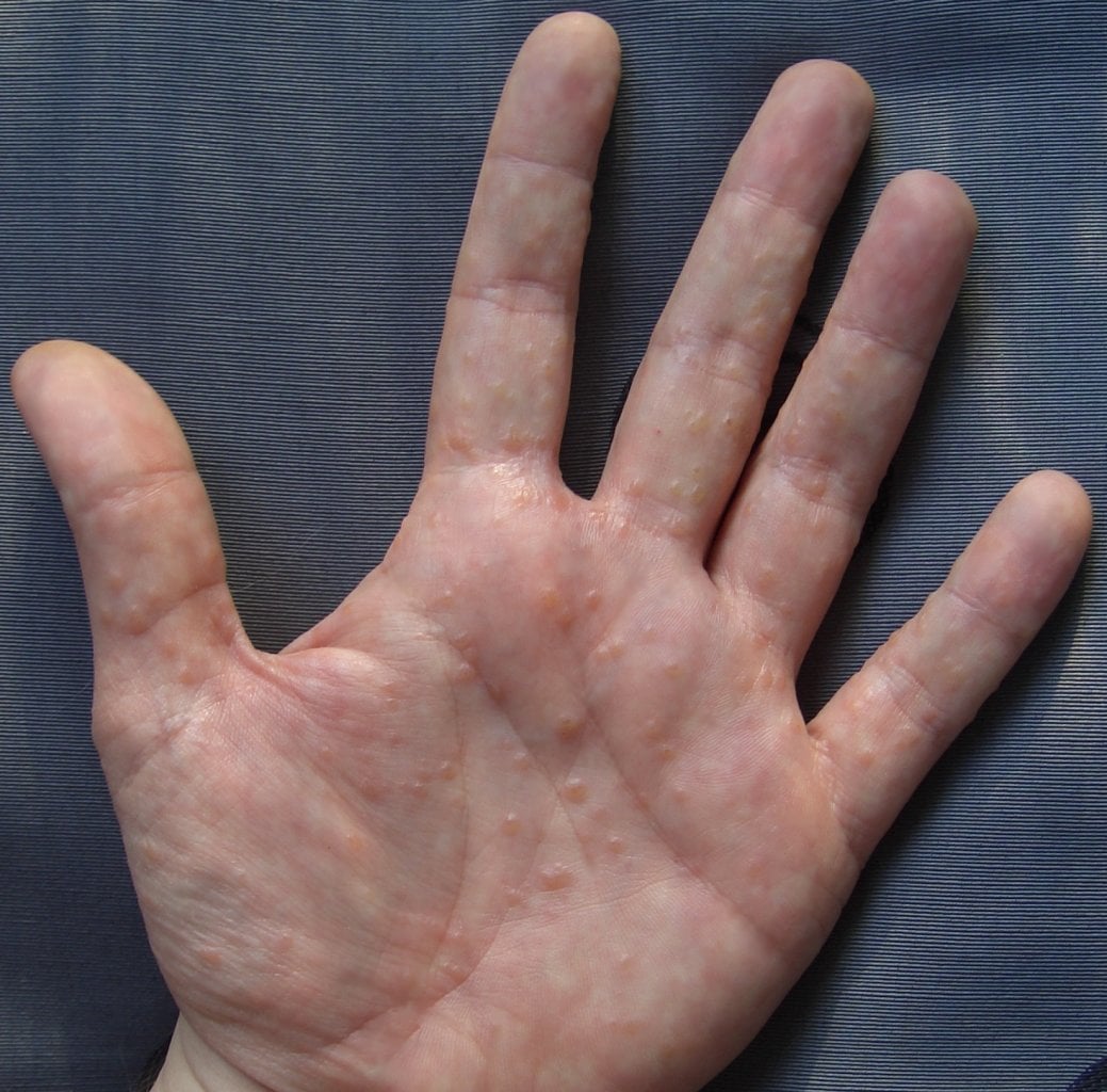 A close-up of a human hand with several small, raised, fluid-filled blisters on the palm, likely indicating a skin condition. The background is a plain, textured surface.