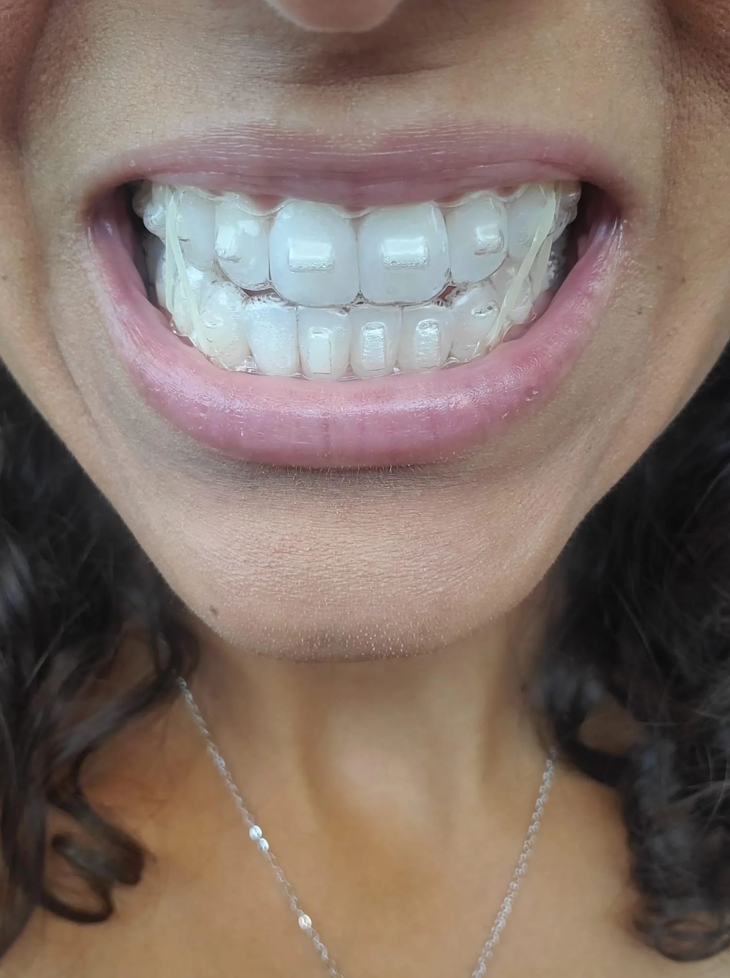 A close-up of a person smiling, showing clear dental aligners on their teeth. Curly dark hair is visible, and the person is wearing a necklace.